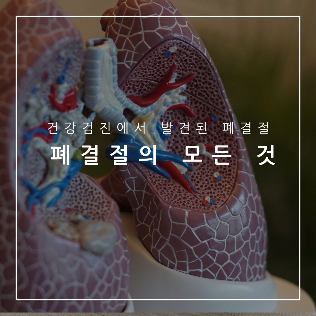 폐결절
