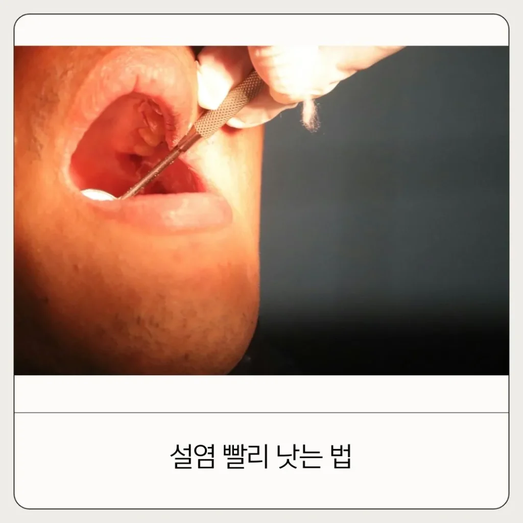 직접 경험해보고 느낀 설염 원인 증상 빨리 낫는 법