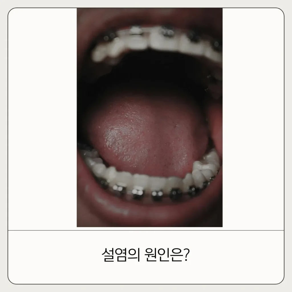 직접 경험해보고 느낀 설염 원인 증상 빨리 낫는 법