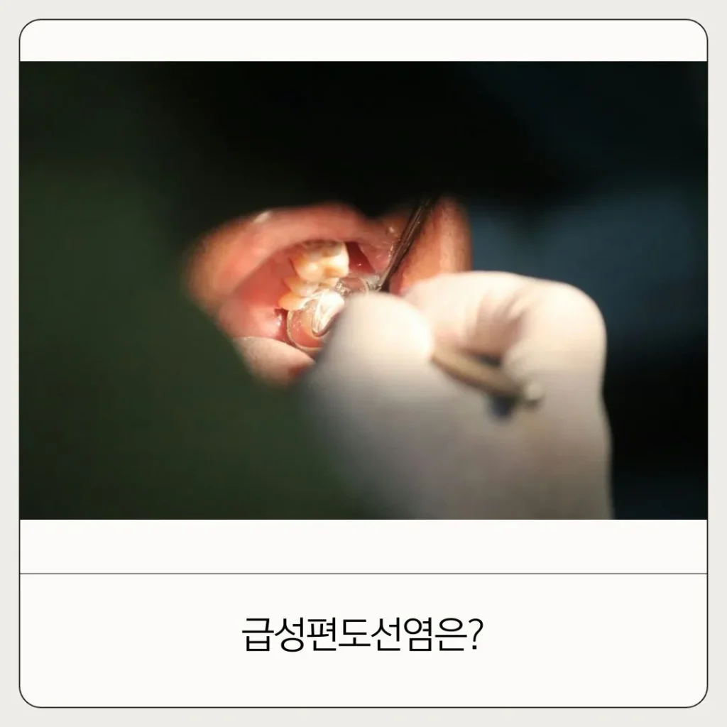 편도선 급성편도선염