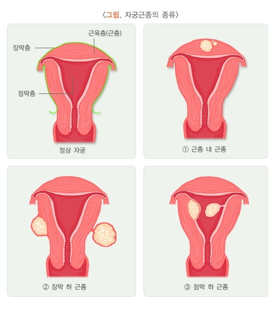 자궁근종 종류